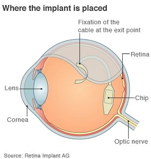 Имплантированный в глаз чип дарит зрение