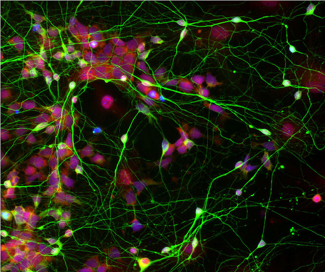 Искусственные стволовые клетки охотятся на опухоль мозга