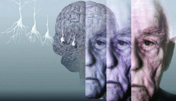 Прогрессирование болезни альцгеймера замедлили на 80 процентов