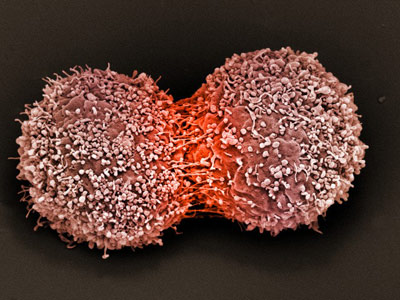 Раковая опухоль растёт благодаря клеточному альтруизму