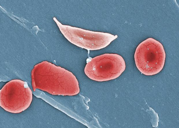 Серповидноклеточную анемию предложили лечить «раздуванием» эритроцитов